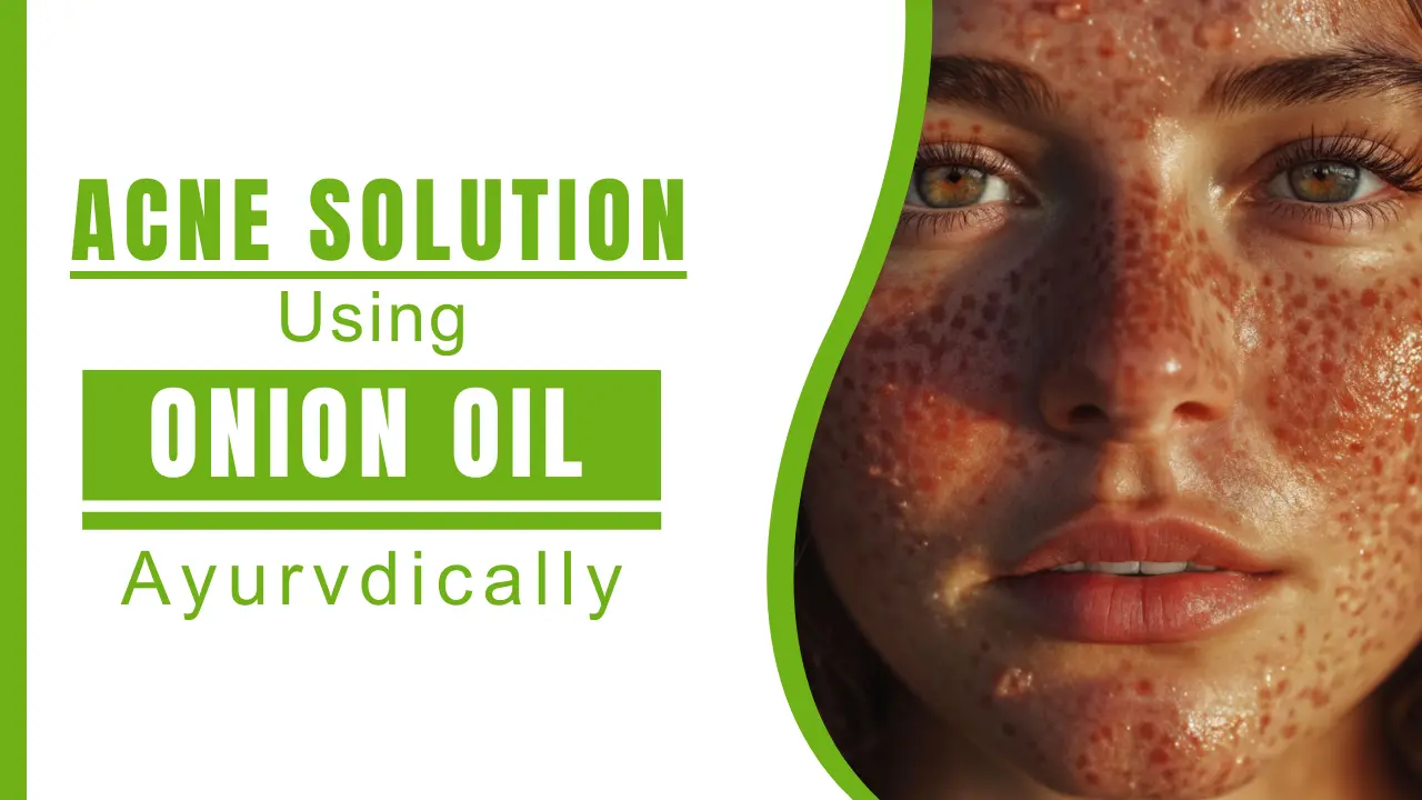 Natural Remedies for Acne Using Ayurveda_ Benefits of Onion Oil