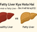 Fatty Liver Kya Hota Hai